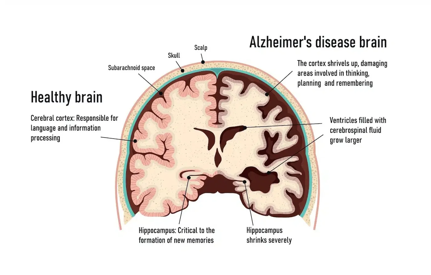 Understanding Dementia